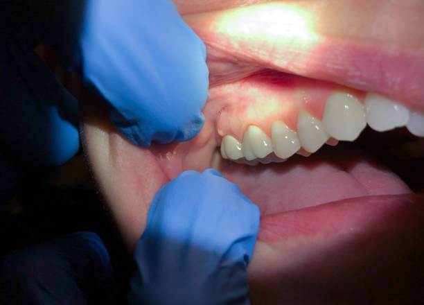 Best Emergency Dental Extractions in Oakland, OK